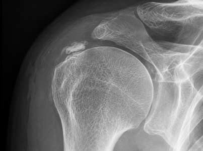 Rx di calcificazione